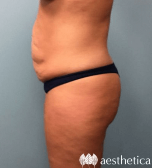 Tummy Tuck before at Aesthetica Plastic Surgery in Lindon, UT