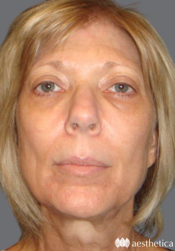 Aesthetica Plastic Surgery eyelid lift after — Lindon, UT