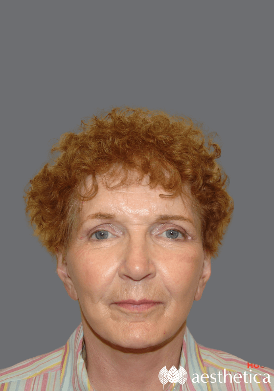 Facelift after at Aesthetica Plastic Surgery in Lindon, UT