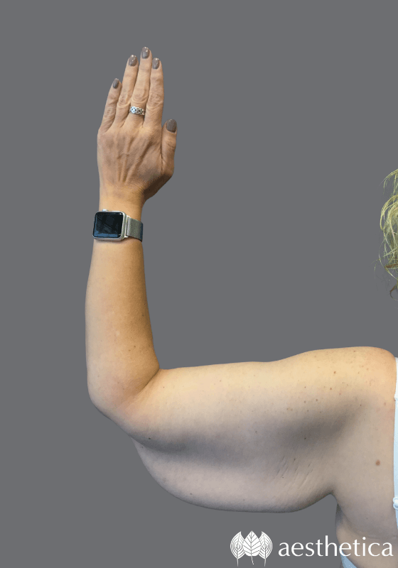 Arm Lift before at Aesthetica Plastic Surgery in Lindon, UT