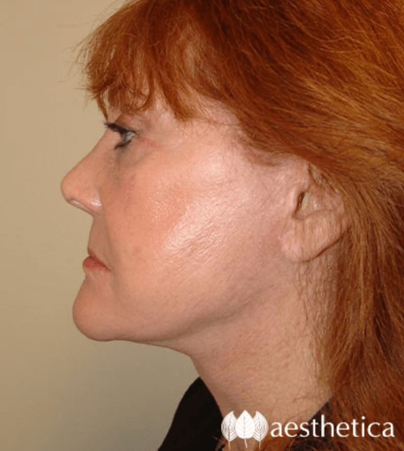 Aesthetica Plastic Surgery facelift after — Lindon, UT