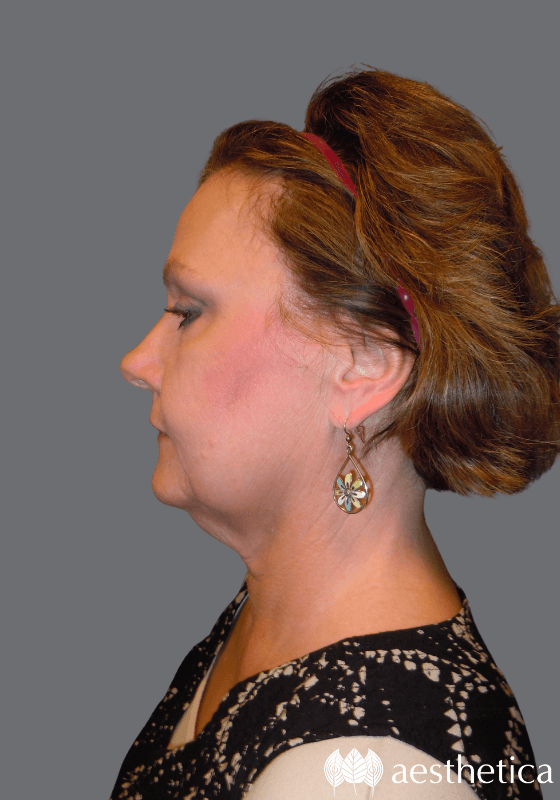 Neck Lift before at Aesthetica Plastic Surgery in Lindon, UT