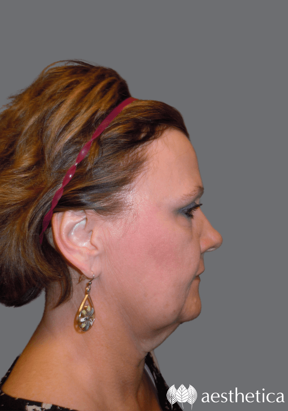 Neck Lift before at Aesthetica Plastic Surgery in Lindon, UT