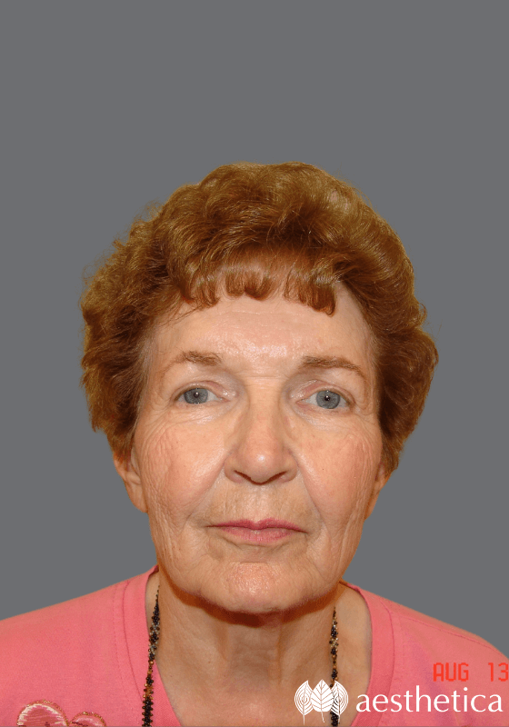 Facelift before at Aesthetica Plastic Surgery in Lindon, UT