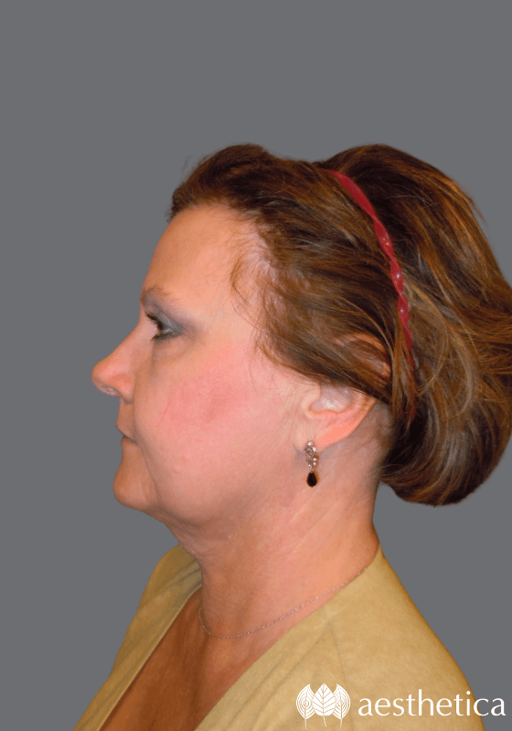 Neck Lift after at Aesthetica Plastic Surgery in Lindon, UT