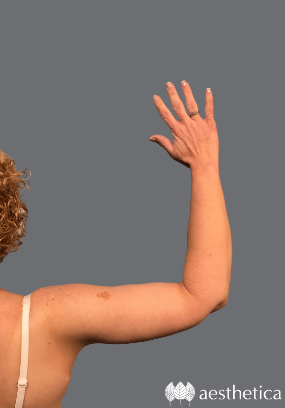 Arm Lift after at Aesthetica Plastic Surgery in Lindon, UT