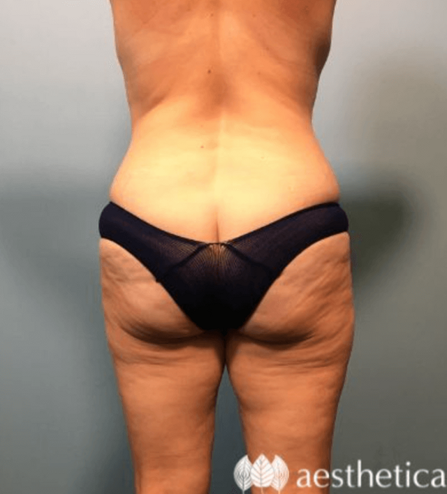 Brazilian Butt Lift before at Aesthetica Plastic Surgery in Lindon, UT