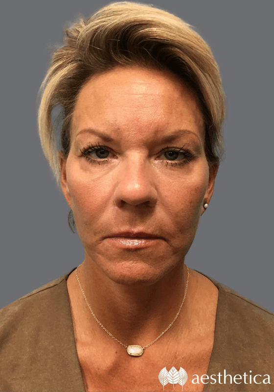 Aesthetica Plastic Surgery facelift after — Lindon, UT
