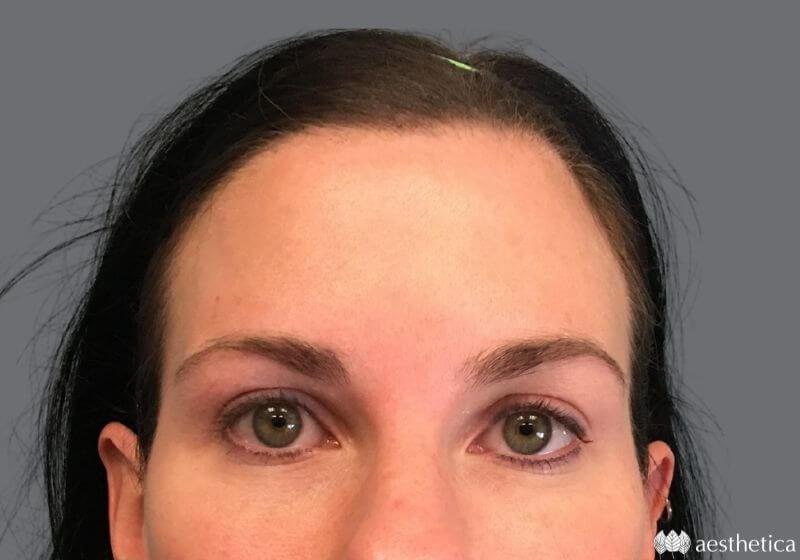Aesthetica Plastic Surgery eyelid lift after — Lindon, UT