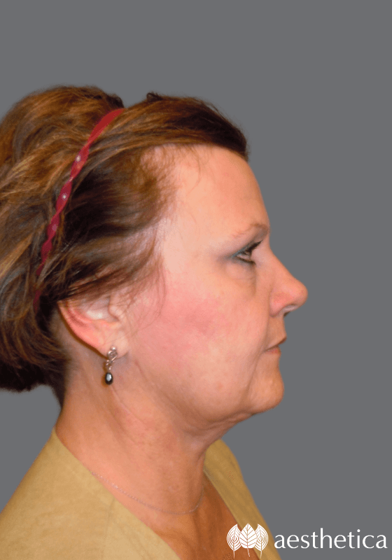Neck Lift after at Aesthetica Plastic Surgery in Lindon, UT