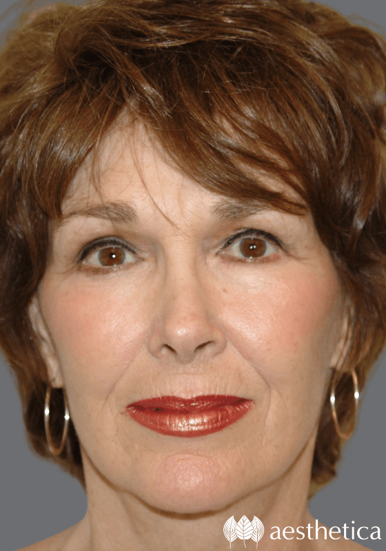 Aesthetica Plastic Surgery facelift after — Lindon, UT