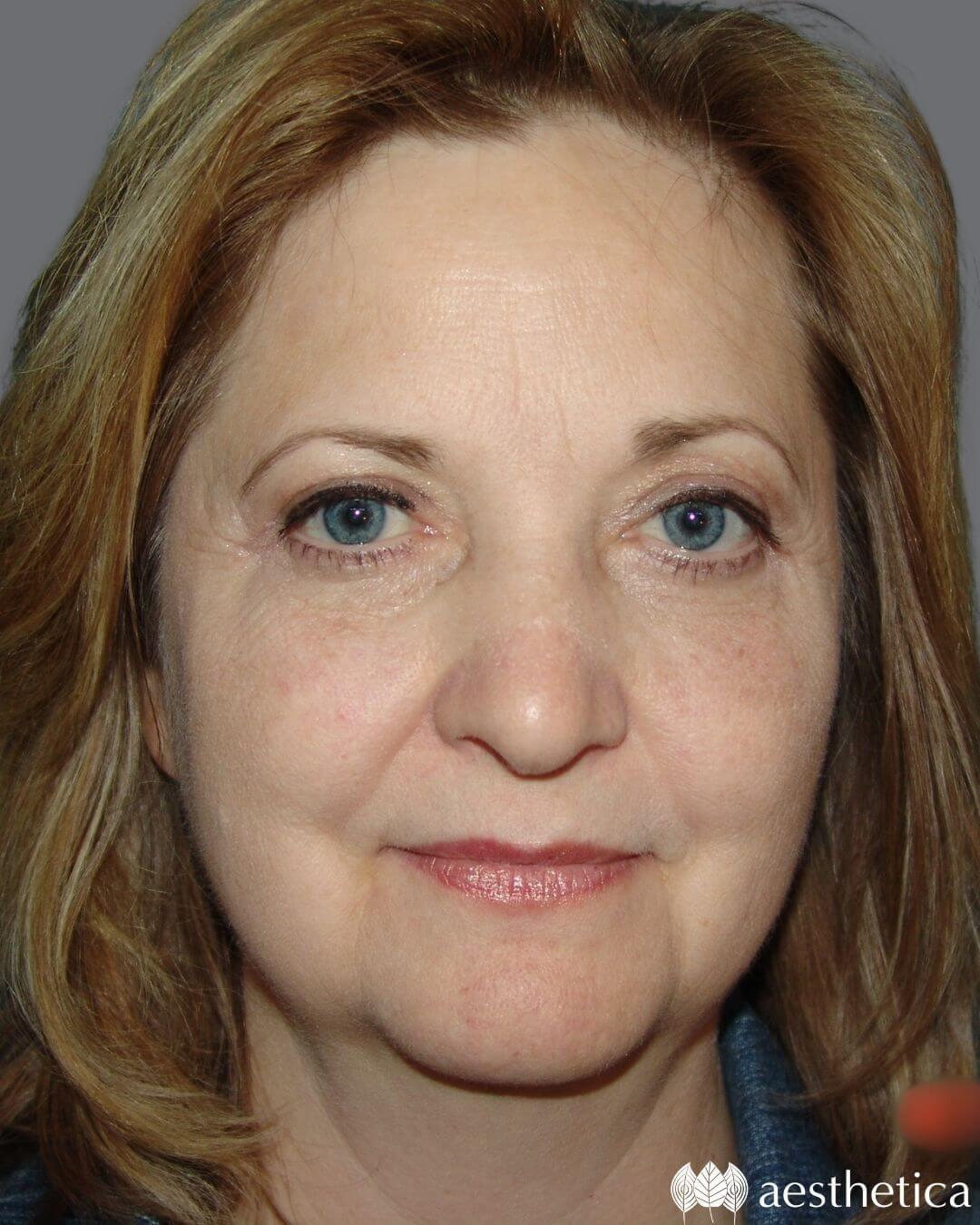 Aesthetica Plastic Surgery eyelid lift after — Lindon, UT