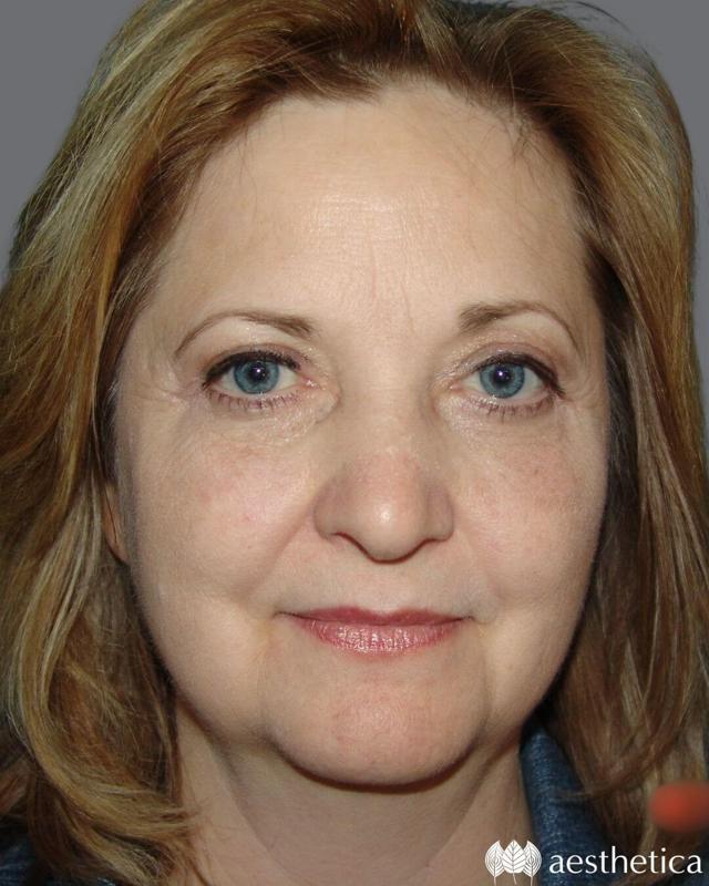 Blepharoplasty after at Aesthetica Plastic Surgery in Lindon, UT