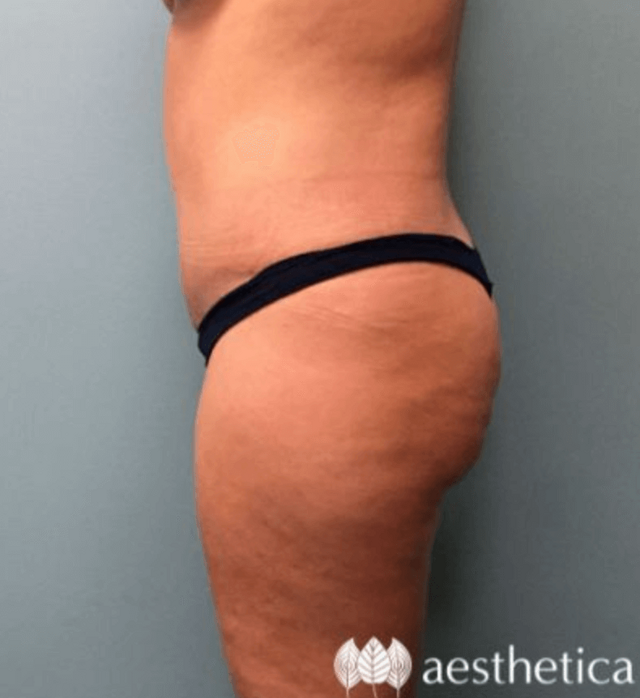 Tummy Tuck after at Aesthetica Plastic Surgery in Lindon, UT