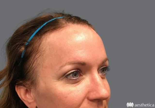 Blepharoplasty after at Aesthetica Plastic Surgery in Lindon, UT