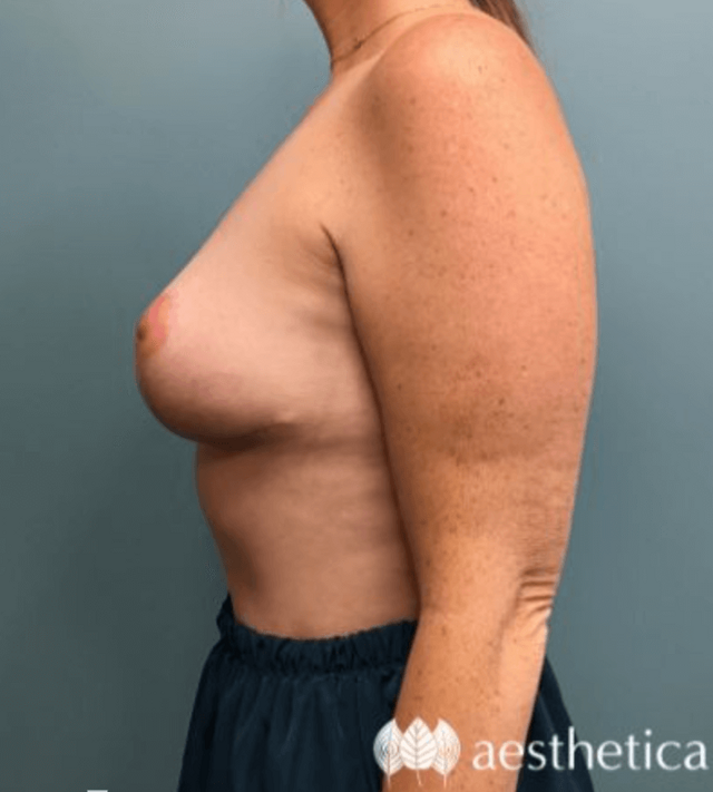 Mommy Makeover after at Aesthetica Plastic Surgery in Lindon, UT