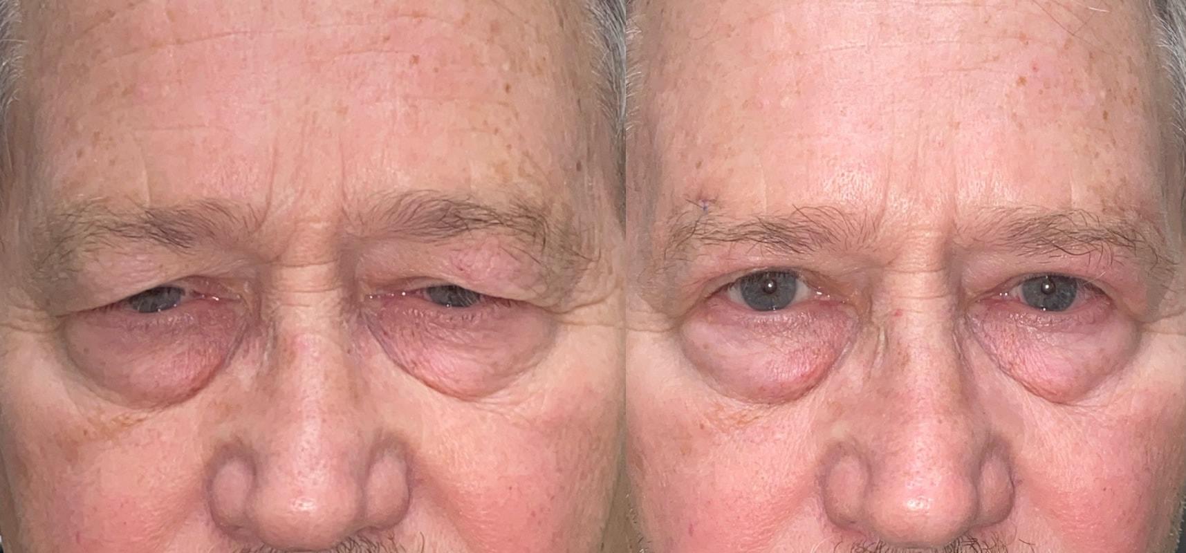 Eyelid Center of Utah eyelid lift result — Heber City, UT