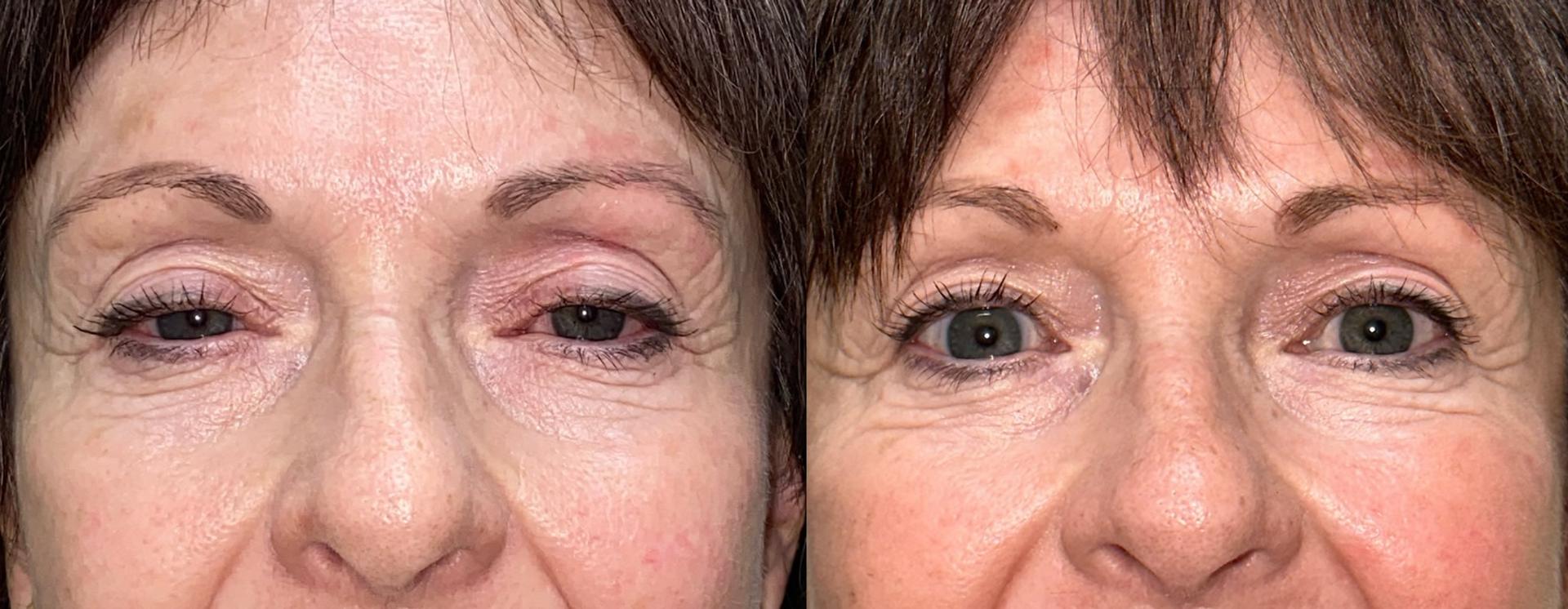 Eyelid Center of Utah eyelid lift result — Heber City, UT