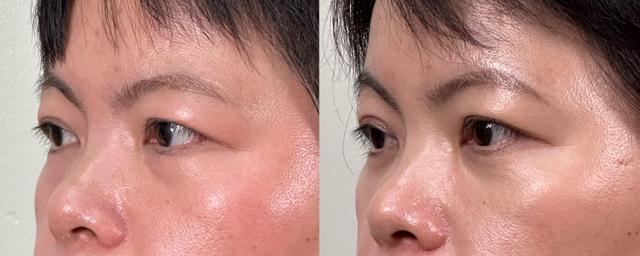 Brow Lift result at Eyelid Center of Utah in Heber City, UT