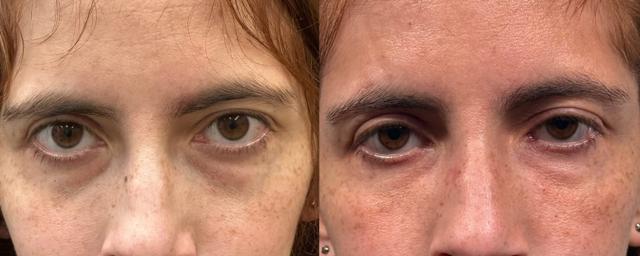 Fat Transfer result at Eyelid Center of Utah in Heber City, UT