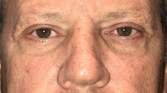 Eyelid Center of Utah eyelid lift after — Heber City, UT