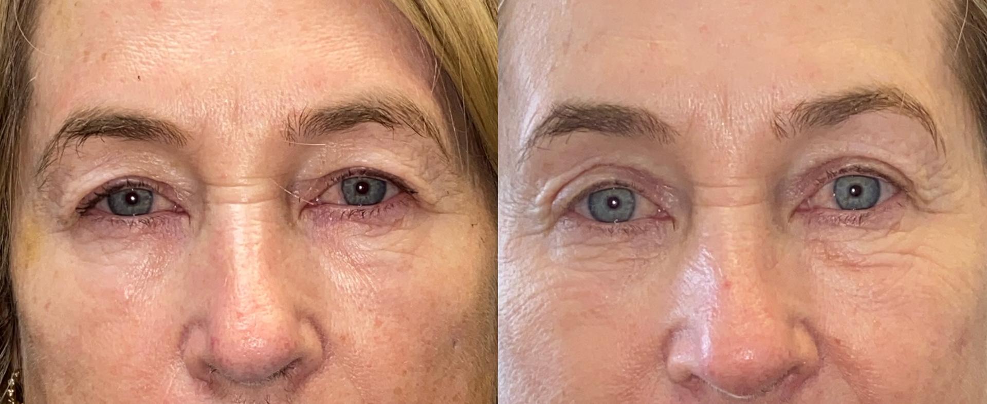 Eyelid Center of Utah eyelid lift result — Heber City, UT