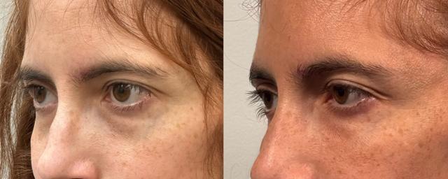 Fat Transfer result at Eyelid Center of Utah in Heber City, UT