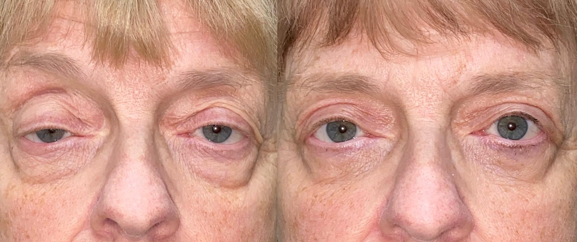 Eyelid Center of Utah eyelid lift result — Heber City, UT