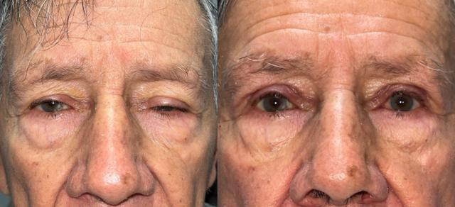 Brow Lift result at Eyelid Center of Utah in Heber City, UT