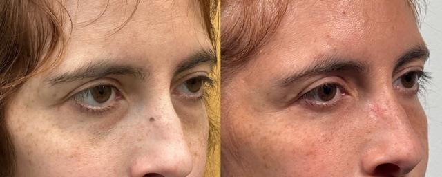 Fat Transfer result at Eyelid Center of Utah in Heber City, UT