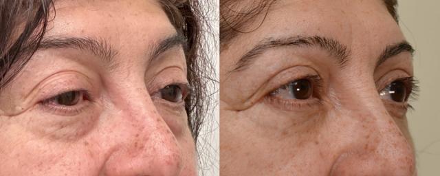 Fat Transfer result at Eyelid Center of Utah in Heber City, UT