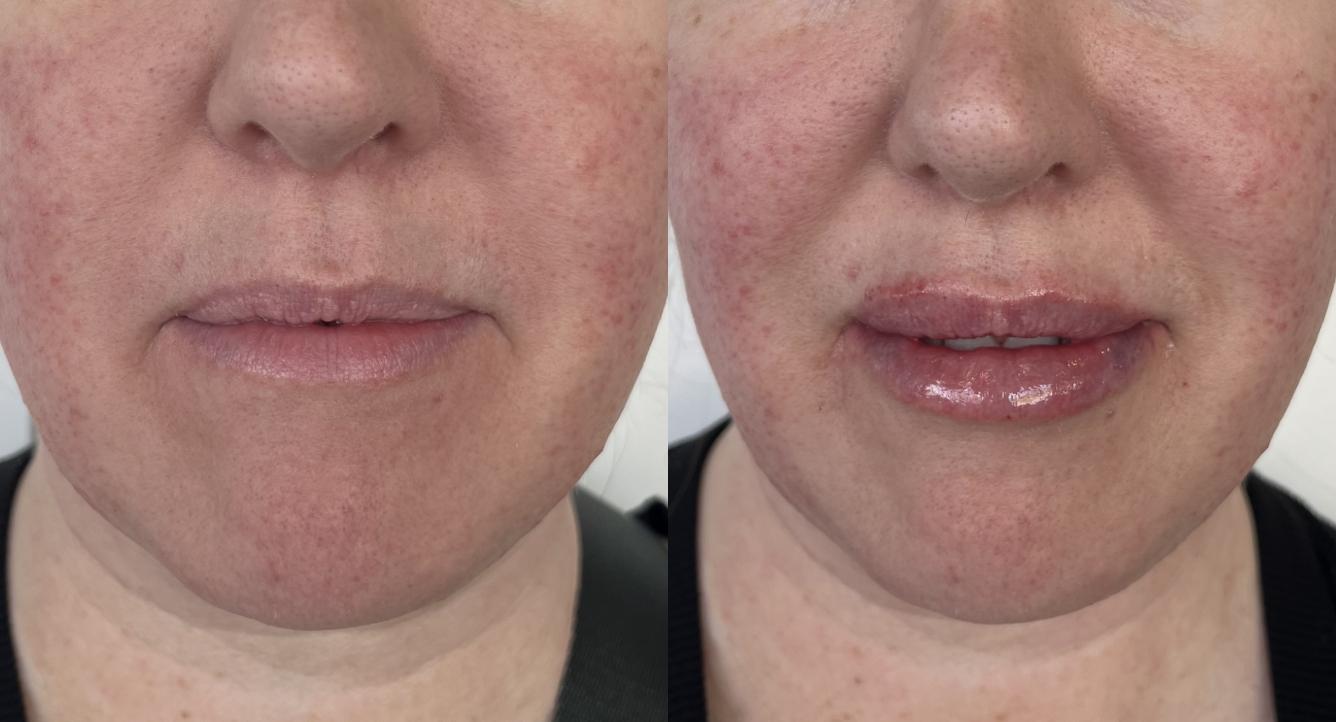 Laura Trapp Aesthetics lip filler result — Omaha, NE