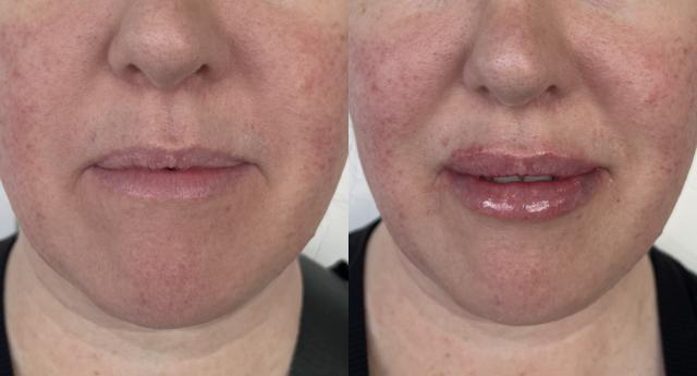 Lip Filler result at Laura Trapp Aesthetics in Omaha, NE