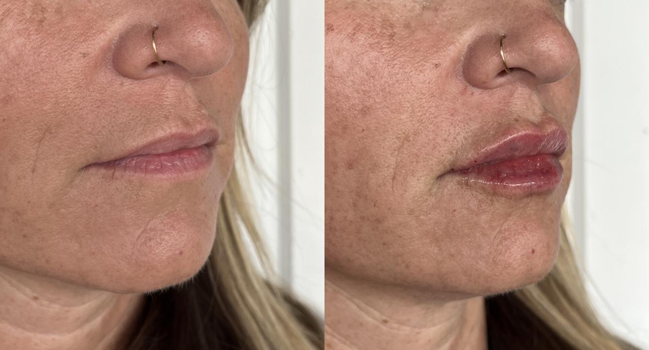 Laura Trapp Aesthetics lip filler result — Omaha, NE