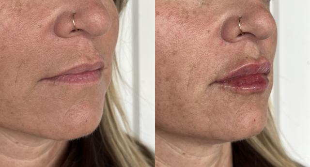 Lip Filler result at Laura Trapp Aesthetics in Omaha, NE