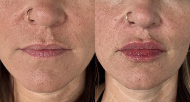 Lip Filler result at Laura Trapp Aesthetics in Omaha, NE