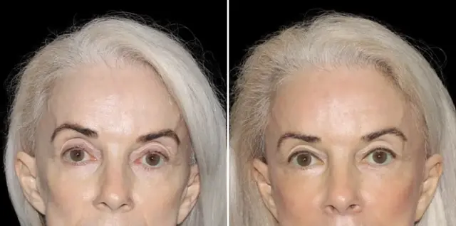 Fat Transfer result at SoCal Aesthetic Surgery in Irvine, CA
