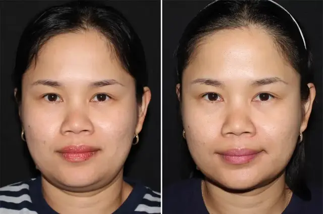 Neck Liposuction result at SoCal Aesthetic Surgery in Irvine, CA