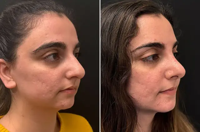 Rhinoplasty result at SoCal Aesthetic Surgery in Irvine, CA