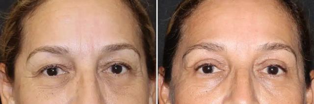 Blepharoplasty result at SoCal Aesthetic Surgery in Irvine, CA