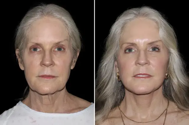 Facelift result at SoCal Aesthetic Surgery in Irvine, CA