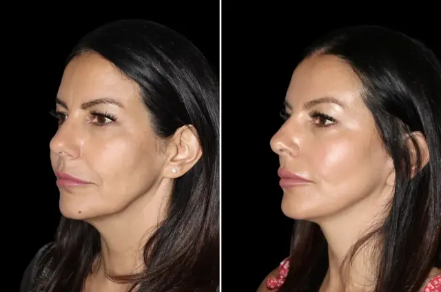 Facelift result at SoCal Aesthetic Surgery in Irvine, CA