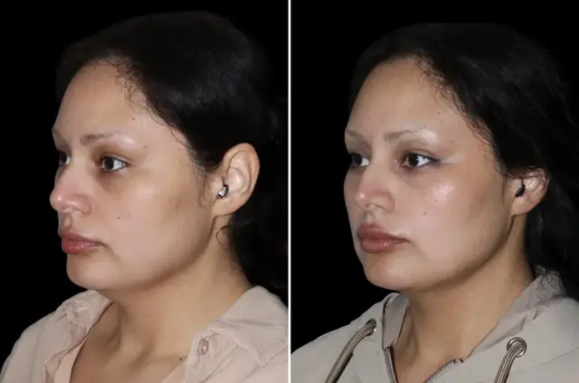 Neck Liposuction result at SoCal Aesthetic Surgery in Irvine, CA