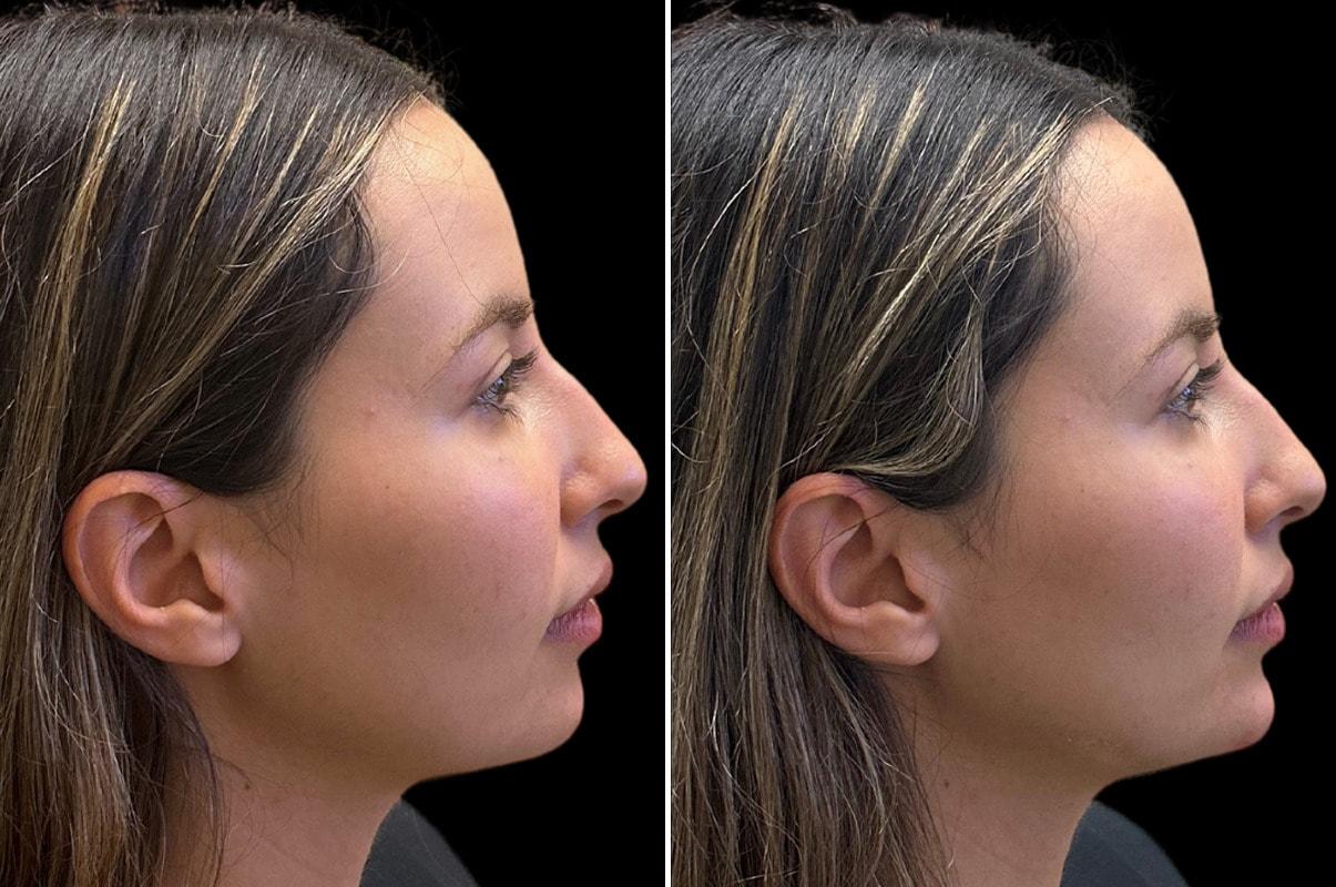 SoCal Aesthetic Surgery jawline filler result — Irvine, CA