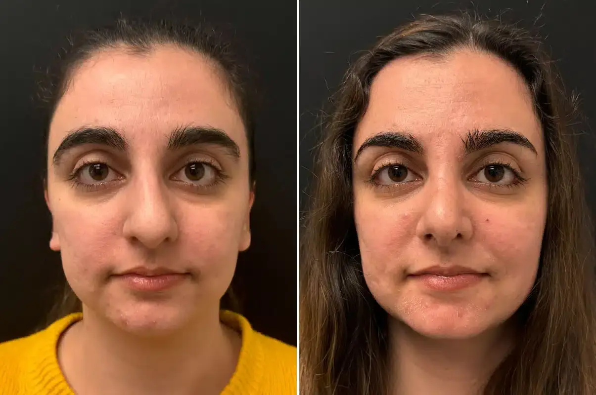 SoCal Aesthetic Surgery rhinoplasty result — Irvine, CA