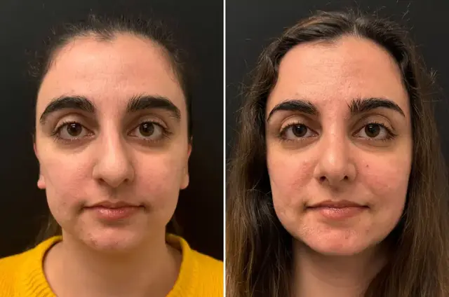 Rhinoplasty result at SoCal Aesthetic Surgery in Irvine, CA