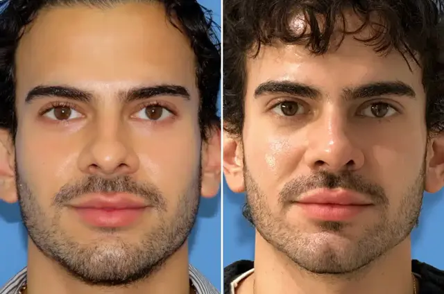 Rhinoplasty result at SoCal Aesthetic Surgery in Irvine, CA