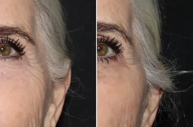 Botox result at SoCal Aesthetic Surgery in Irvine, CA