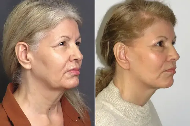 Blepharoplasty result at SoCal Aesthetic Surgery in Irvine, CA