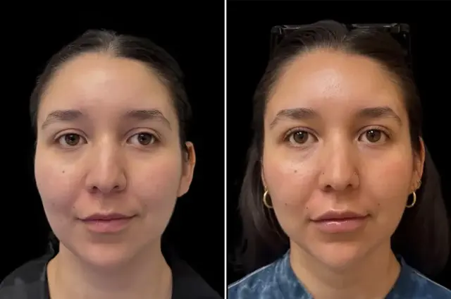 Neck Liposuction result at SoCal Aesthetic Surgery in Irvine, CA